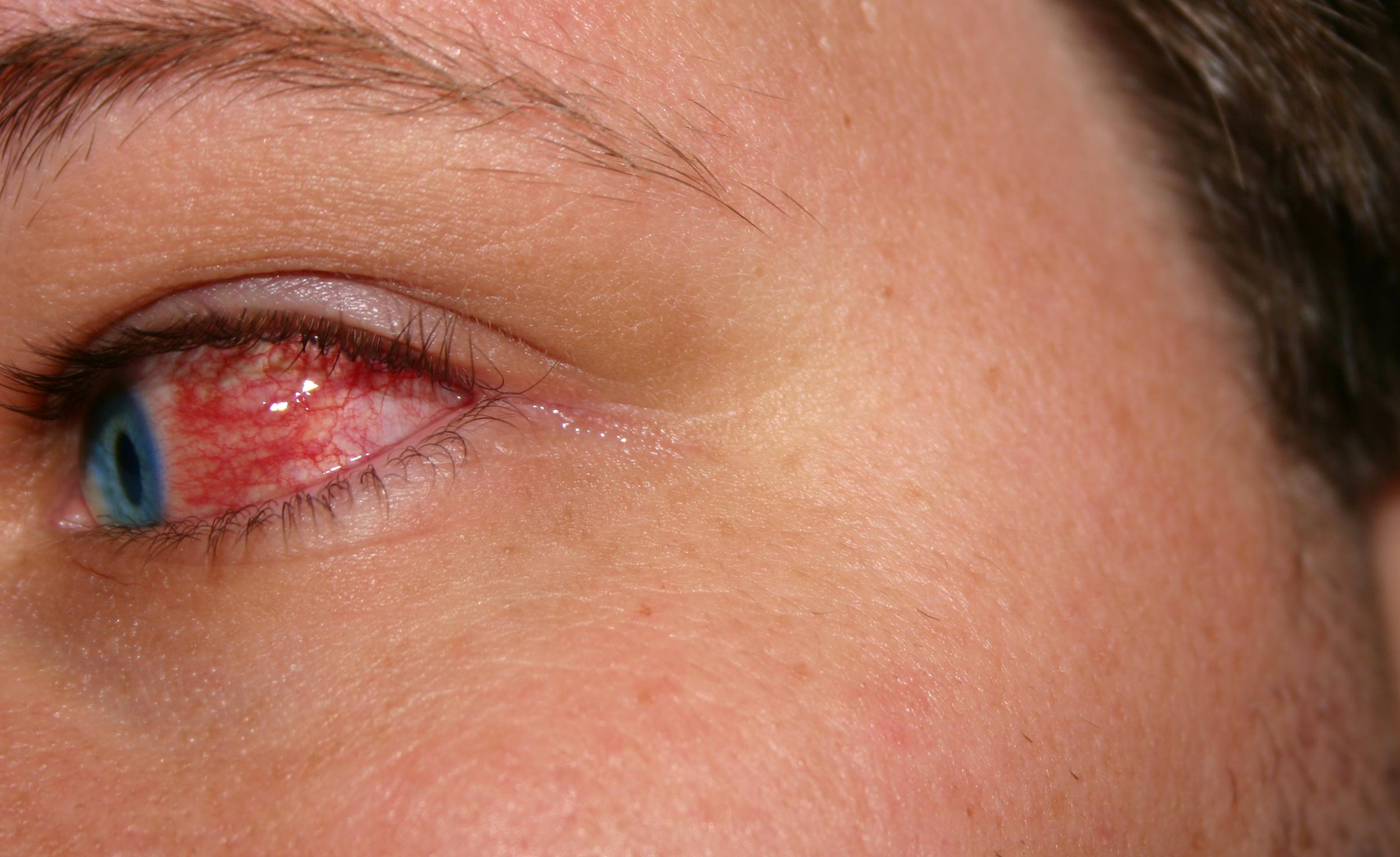 Ocular diseases